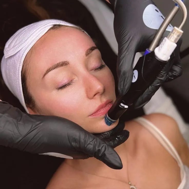 Woman receiving a cosmetic facial treatment with a micro-needling device.