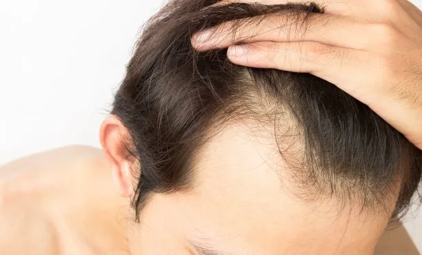 A person with dark hair touches their head, revealing a receding hairline. The background is plain white, conveying a neutral and introspective mood.