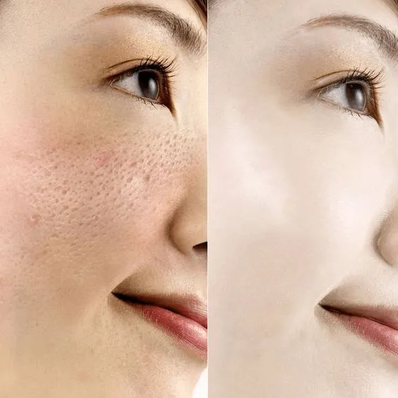 Close-up of a woman's face divided in half; left side shows visible pores and redness, right side is smooth and even-toned, illustrating skincare.