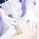 A technician in white gloves uses a handheld laser device on a person's leg for hair removal. The setting appears clinical and professional.