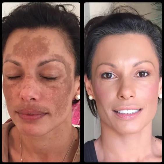 Split image of a woman before and after makeup. The left shows dark facial pigmentation with closed eyes; the right shows clear skin and a smile.